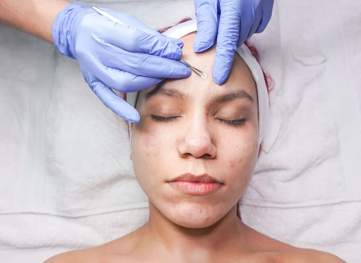 Facial Control de Acné